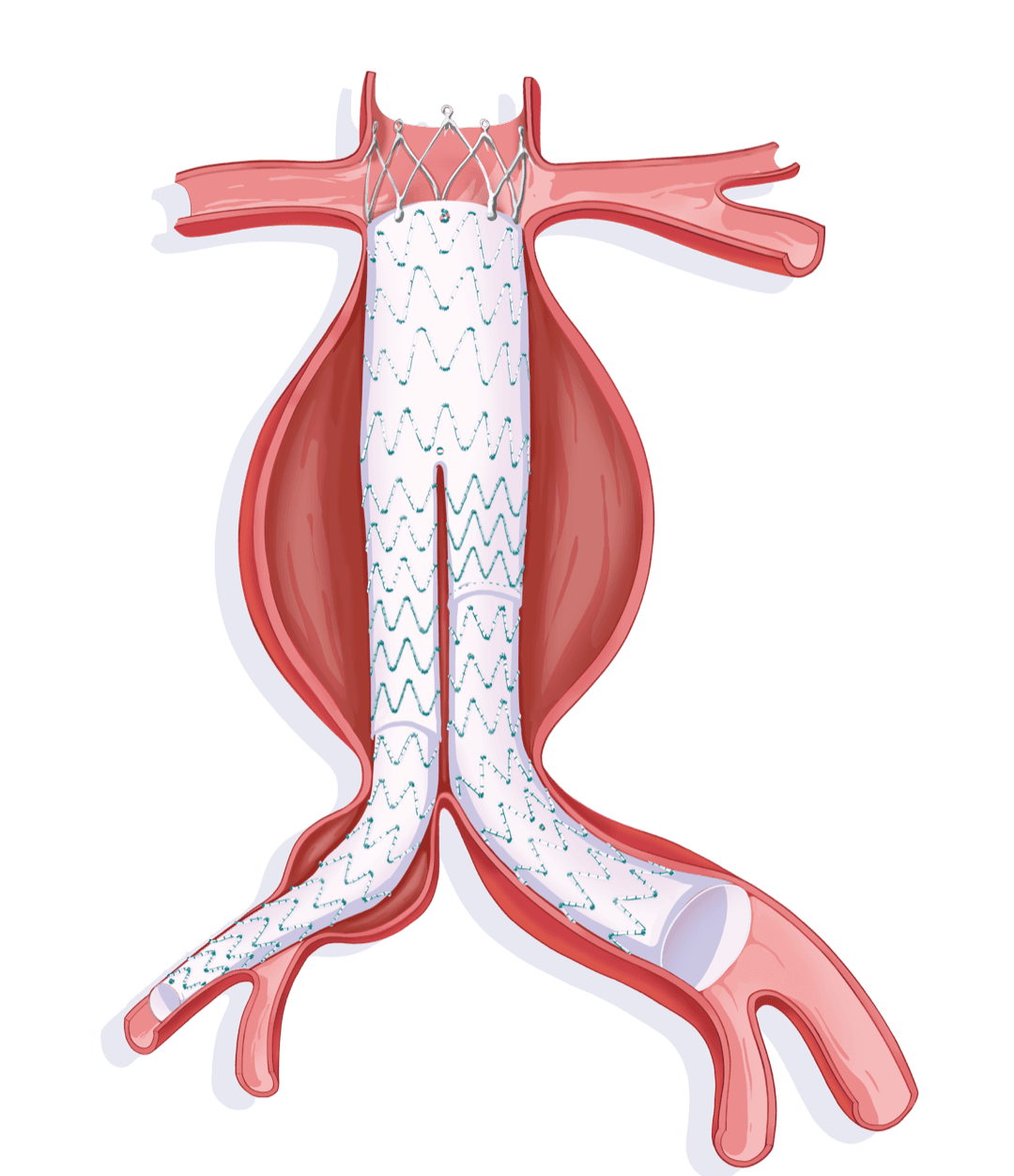 Percutek Tycheseal™ AAA System — anatomical illustration of the stent graft in the aorta