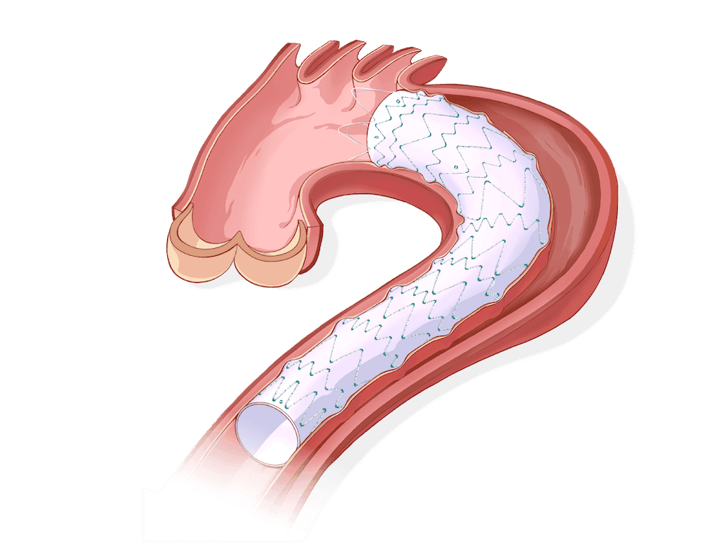 Percutek Tycheseal™ TAA System — anatomical illustration of the stent graft in the aorta